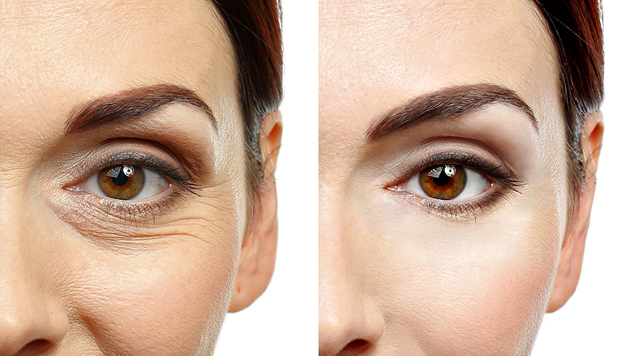 eyelid surgery denver