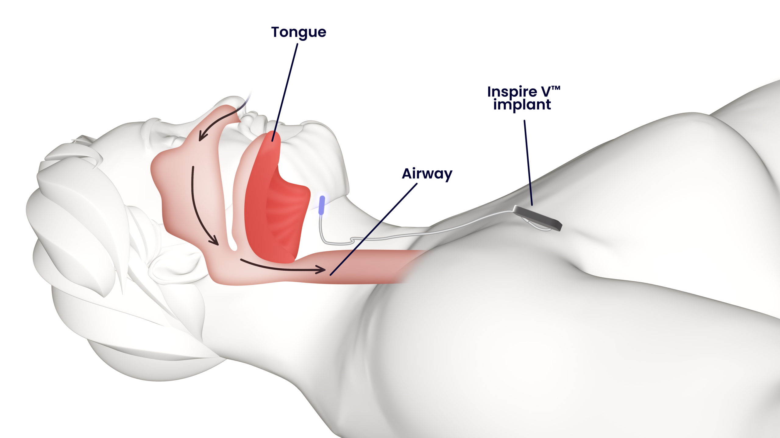 An illustration showing a sleeping person with an Inspire implant.
