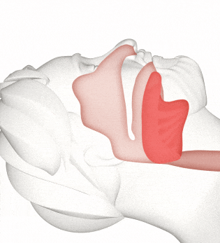 An animated illustration shows how sleep apnea blocks clear breathing.