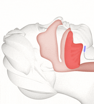 An animated illustration shows how breathing is clear with Inspire.